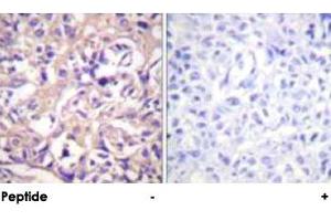 Immunohistochemical analysis of paraffin-embedded human breast carcinoma tissue using TK1 polyclonal antibody . (TK1 抗体  (Ser13))