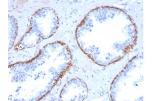 Formalin-fixed, paraffin-embedded human Prostate Carcinoma stained with Cytokeratin 5 Mouse Monoclonal Antibody (KRT5/3594). (Cytokeratin 5 抗体  (AA 316-590))