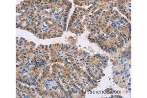 Immunohistochemistry of Human thyroid cancer using NCR1 Polyclonal Antibody at dilution of 1:20 (NCR1 抗体)