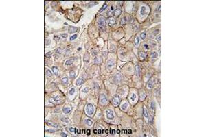 Formalin-fixed and paraffin-embedded human lung carcinoma tissue reacted with CLIC1 antibody, which was peroxidase-conjugated to the secondary antibody, followed by DAB staining. (CLIC1 抗体)