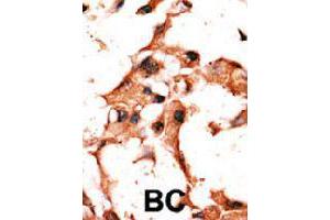Formalin-fixed and paraffin-embedded human cancer tissue reacted with BIRC3 polyclonal antibody  , which was peroxidase-conjugated to the secondary antibody, followed by DAB staining. (BIRC3 抗体  (N-Term))