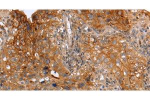 Immunohistochemistry of paraffin-embedded Human cervical cancer using PLAUR Polyclonal Antibody at dilution of 1:60 (PLAUR 抗体)