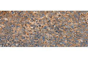 Immunohistochemistry of paraffin-embedded Human cervical cancer tissue using MYL12B Polyclonal Antibody at dilution of 1:25(x200) (MYL12B 抗体)