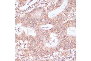 Immunohistochemistry of paraffin-embedded human colon carcinoma using BYSL antibody (ABIN6129546, ABIN6137672, ABIN6137674 and ABIN6215553) at dilution of 1:100 (40x lens). (Bystin-Like 抗体  (AA 120-280))