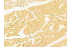 ABIN6262561 and ABIN6278898 at 1/100 staining human tongue carcinoma by IHC-P. (IL28B 抗体  (Internal Region))