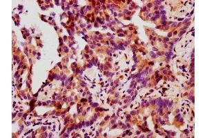 IHC image of ABIN7127700 diluted at 1:100 and staining in paraffin-embedded human lung cancer performed on a Leica BondTM system.