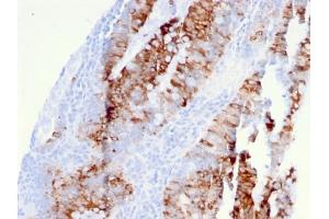 Formalin-fixed, paraffin-embedded human colon carcinoma stained with DR5 Mouse Monoclonal Antibody (DR5/3381).