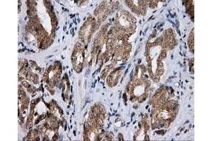 Immunohistochemical staining of paraffin-embedded Adenocarcinoma of ovary tissue using anti-LIPG mouse monoclonal antibody. (LIPG 抗体)