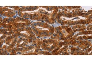 Immunohistochemistry of paraffin-embedded Human thyroid cancer tissue using NCR1 Polyclonal Antibody at dilution 1:30 (NCR1 抗体)