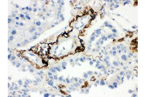 Anti- Vitronectin Picoband antibody, IHC(P) IHC(P): Human Lung Cancer Tissue
