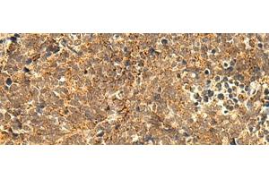 Immunohistochemistry of paraffin-embedded Human lung cancer tissue using ABHD10 Polyclonal Antibody at dilution of 1:50(x200) (ABHD10 抗体)