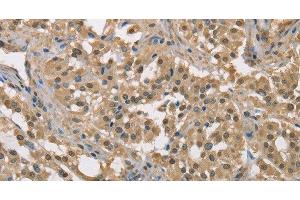 Immunohistochemistry of paraffin-embedded Human thyroid cancer tissue using DACH2 Polyclonal Antibody at dilution 1:40 (DACH2 抗体)