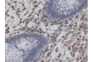DAB staining on IHC-P; Samples: Human Colorectal cancer Tissue (NFIA 抗体  (AA 1-143))