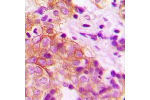 Immunohistochemical analysis of MARK2 staining in human prostate cancer formalin fixed paraffin embedded tissue section. (MARK2 抗体  (N-Term))