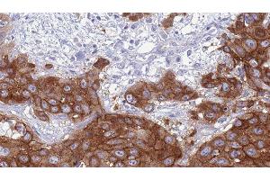 ABIN6276897 at 1/100 staining Human Head and neck cancer tissue by IHC-P.