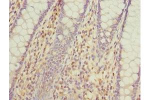 Immunohistochemistry of paraffin-embedded human colon cancer using ABIN7163880 at dilution of 1:100 (GALNT2 抗体  (AA 442-571))