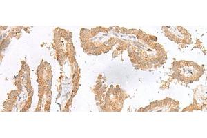 Immunohistochemistry of paraffin-embedded Human thyroid cancer tissue using CXCL6 Polyclonal Antibody at dilution of 1:45(x200) (CXCL6 抗体)
