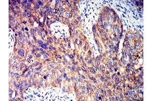 Immunohistochemical analysis of paraffin-embedded cervical cancer tissues using PRKAB2 mouse mAb with DAB staining. (PRKAB2 抗体  (AA 1-120))