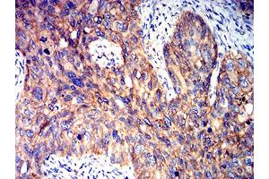 Immunohistochemical analysis of paraffin-embedded cervical cancer tissues using PRKAB2 mouse mAb with DAB staining.