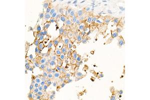 Immunohistochemistry (IHC) image for anti-Carcinoembryonic Antigen-Related Cell Adhesion Molecule 5 (CEACAM5) antibody (ABIN7266084)