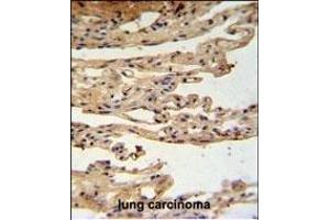 FKBPL Antibody (C-term) (ABIN1881347 and ABIN2840192) IHC analysis in formalin fixed and paraffin embedded lung carcinoma followed by peroxidase conjugation of the secondary antibody and DAB staining. (FKBPL 抗体  (C-Term))