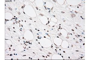 Immunohistochemical staining of paraffin-embedded Carcinoma of kidney tissue using anti-PLK1mouse monoclonal antibody. (PLK1 抗体)