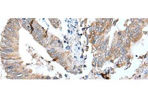 Immunohistochemistry of paraffin-embedded Human colorectal cancer tissue using GKN1 Polyclonal Antibody at dilution of 1:30(x200) (Gastrokine 1 抗体)