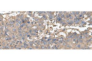 Immunohistochemistry of paraffin-embedded Human liver cancer tissue using BLOC1S6 Polyclonal Antibody at dilution of 1:95(x200) (Pallidin 抗体)