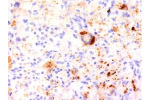Formalin-fixed, paraffin-embedded human Erdheim-Chester disease (also known as polyostotic sclerosing histiocytosis) stained with TNF alpha Monoclonal Antibody (TNF706). (TNF alpha 抗体  (N-Term))