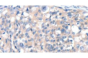 Immunohistochemistry of paraffin-embedded Human breast cancer tissue using GRIN2D Polyclonal Antibody at dilution 1:30 (GRIN2D 抗体)