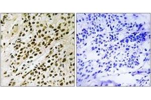 Immunohistochemistry analysis of paraffin-embedded human breast carcinoma, using MAPKAPK5 (Phospho-Thr182) Antibody. (MAPKAP Kinase 5 抗体  (pThr182))