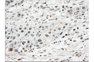 Immunohistochemical staining of paraffin-embedded Carcinoma of pancreas tissue using anti-TYRO3mouse monoclonal antibody. (TYRO3 抗体)