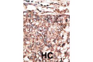 Immunohistochemical staining (Formalin-fixed paraffin-embedded sections) of human hepatocarcinoma. (PDGFD 抗体  (AA 313-341))