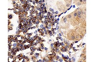 Immunohistochemistry analysis of paraffin-embedded human stomach cancer using CD192 Polyclonal Antibody at dilution of 1:300. (CCR2 抗体)