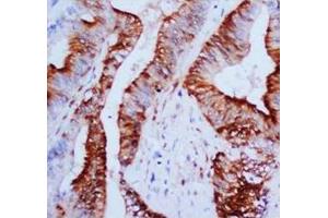 Immunohistochemical analysis of paraffin embedded Mammary cancer sections, staining MAPK1-3 in cytoplasm and nucleus, DAB chromogenic reaction (ERK1/2 抗体  (N-Term))