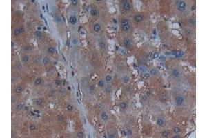 Detection of Cys-C in Human Liver cancer Tissue using Polyclonal Antibody to Cystatin C (Cys-C) (CST3 抗体  (AA 27-146))
