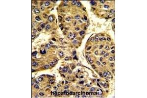 Formalin-fixed and paraffin-embedded human hepatocarcinoma with ASPN Antibody (Center), which was peroxidase-conjugated to the secondary antibody, followed by DAB staining. (Asporin 抗体  (AA 242-269))