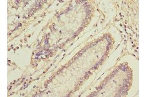 Immunohistochemistry of paraffin-embedded human colon cancer using ABIN7160476 at dilution of 1:100 (MLF1 抗体  (AA 1-268))