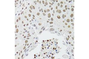 Immunohistochemistry of paraffin-embedded human lung cancer using CDX2 antibody (ABIN1871774) at dilution of 1:100 (40x lens).
