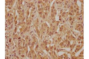 IHC image of ABIN7175710 diluted at 1:300 and staining in paraffin-embedded human liver cancer performed on a Leica BondTM system. (MORG1 抗体  (AA 64-315))
