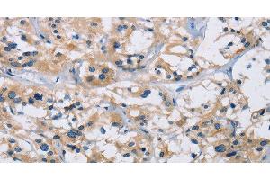 Immunohistochemistry of paraffin-embedded Human thyroid cancer using IL17RB Polyclonal Antibody at dilution of 1:40 (IL17 Receptor B 抗体)