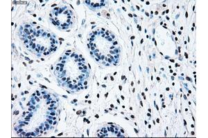 Immunohistochemical staining of paraffin-embedded breast tissue using anti-BRAF mouse monoclonal antibody. (BRAF 抗体)