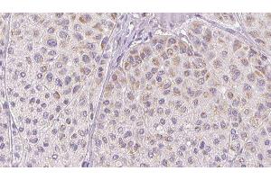 ABIN6277763 at 1/100 staining Human melanoma tissue by IHC-P. (CCL2 抗体  (Internal Region))
