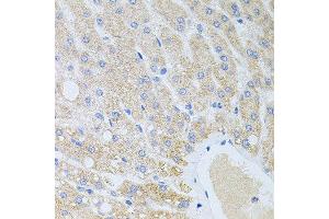 Immunohistochemistry of paraffin-embedded human liver injury using DLK1 antibody at dilution of 1:100 (x40 lens).