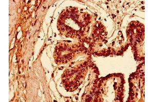 Immunohistochemistry of paraffin-embedded human breast cancer using ABIN7157408 at dilution of 1:100 (KRT81 抗体  (AA 3-505))