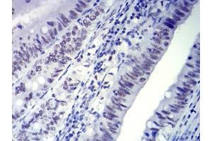 Immunohistochemical analysis of paraffin-embedded rectum cancer tissues using CTNNBL1 mouse mAb with DAB staining. (CTNNBL1 抗体  (AA 390-557))