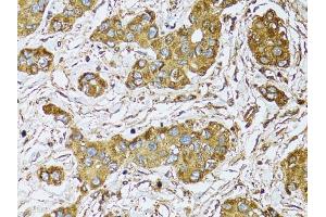Immunohistochemistry of paraffin-embedded human liver cancer using μgDH antibody (ABIN5970552) at dilution of 1/100 (40x lens). (UGDH 抗体)