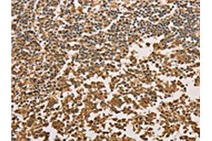 The image on the left is immunohistochemistry of paraffin-embedded Human tonsil tissue using ABIN7131042(SETD2 Antibody) at dilution 1/40, on the right is treated with fusion protein.