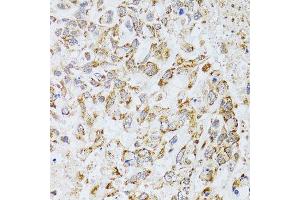 Immunohistochemistry of paraffin-embedded human lung cancer using AIFM3 antibody (ABIN5996156) at dilution of 1/100 (40x lens). (AIFM3 抗体)