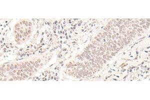 Immunohistochemistry of paraffin-embedded Human esophagus cancer tissue using ZBED1 Polyclonal Antibody at dilution of 1:40(x200) (ZBED1 抗体)